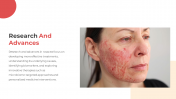 300832-Rosacea_13