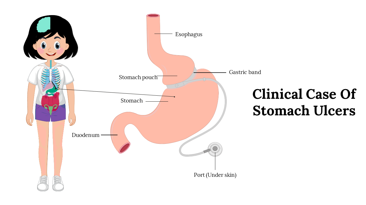 Illustration of a gastric system showing the esophagus, stomach pouch, stomach, and duodenum with a labeled diagram.