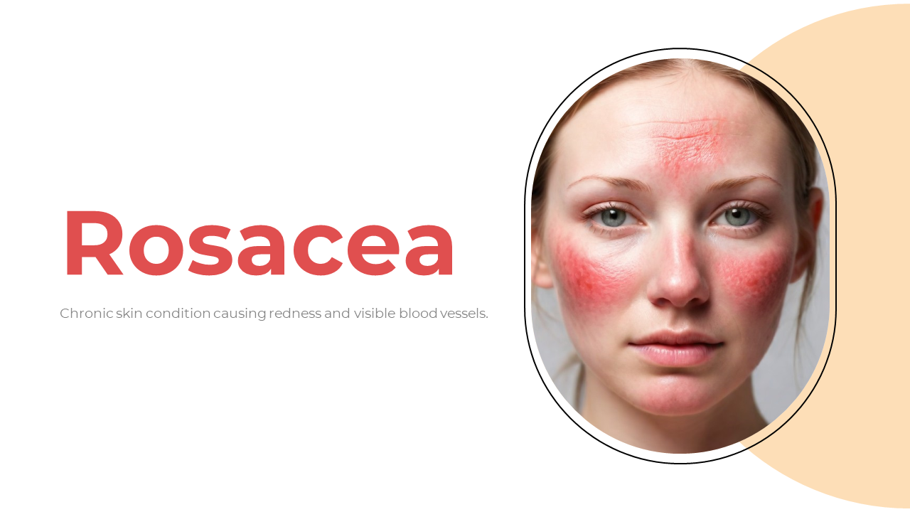 Slide deck explaining rosacea, with photos of affected skin, charts, and treatment options, using beige theme.