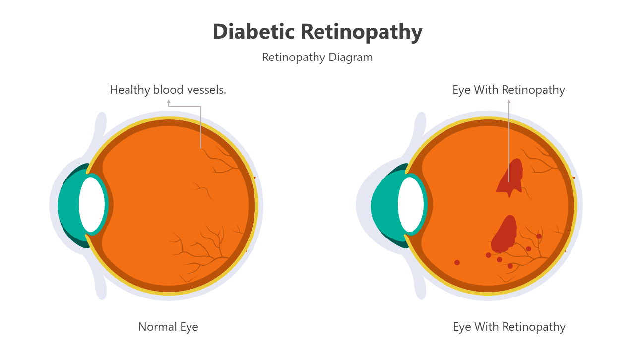 Optimize Diabetic Retinopathy PowerPoint And Google Slides