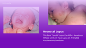 300374-world-lupus-day-presentation-13