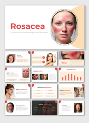 Easy To Customizable Rosacea PowerPoint And Google Slides