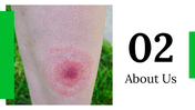 400310-lyme-disease-awareness-month-05