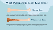 704824-world-osteoporosis-day-10